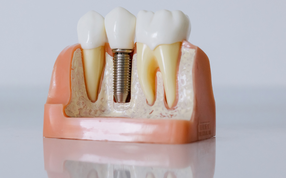 Dental Implants in Edmonton